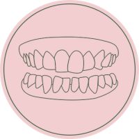 Apiñamiento dental